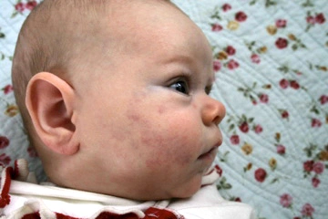 Types of Venous Malformations